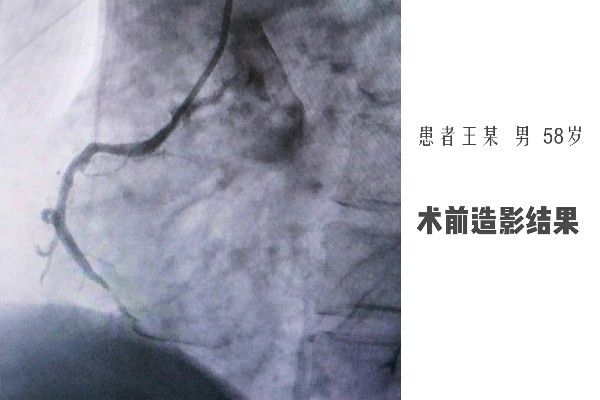 术前造影结果