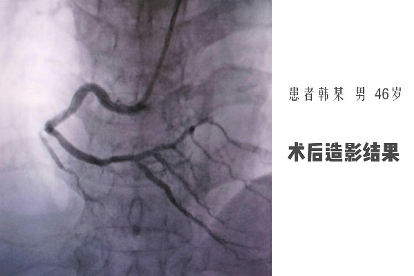 术后造影结果