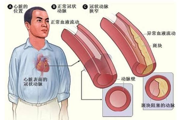 老烟枪患冠心病来我院解病痛