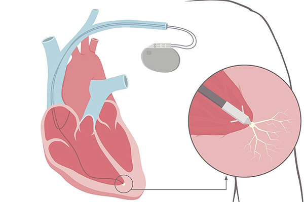 我院成功为耋耄老人置换心脏起搏器