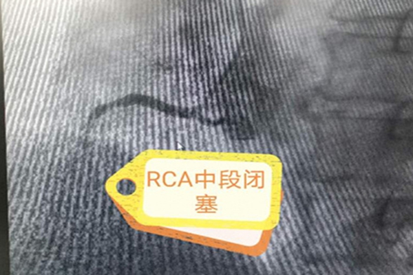 PCA中段闭塞
