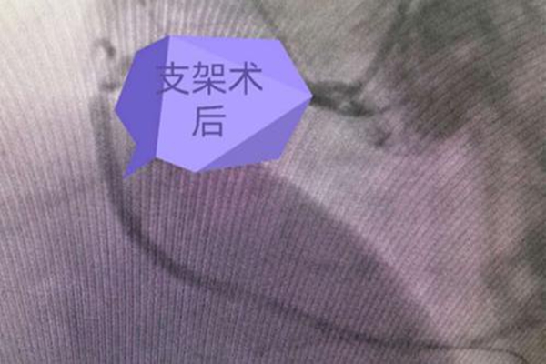 支架术后