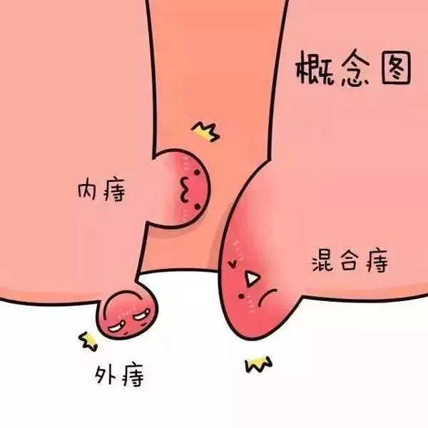 痔疮概念图