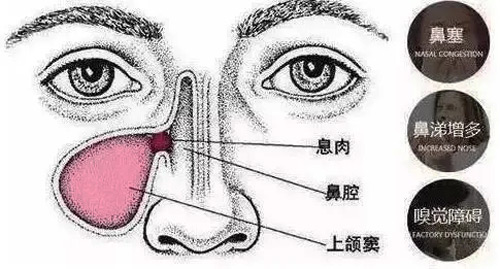 鼻息肉有哪些症状表现？