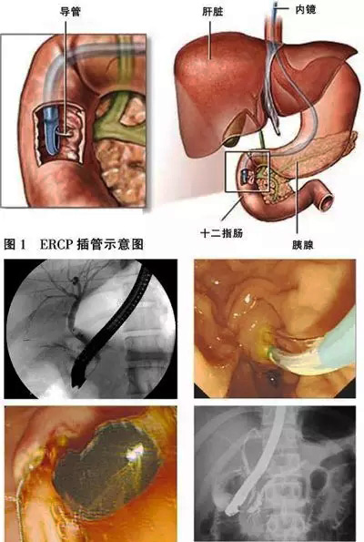 ERCP技术