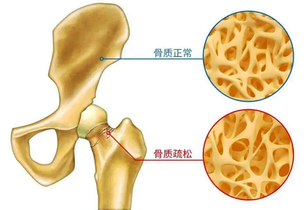 骨质疏松九大常见误区你了解吗？