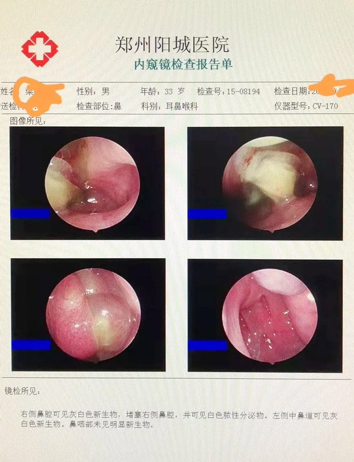 鼻内窥镜检查见右侧中鼻道新生物