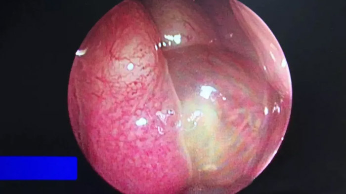 鼻内窥镜检查见右侧中鼻道新生物