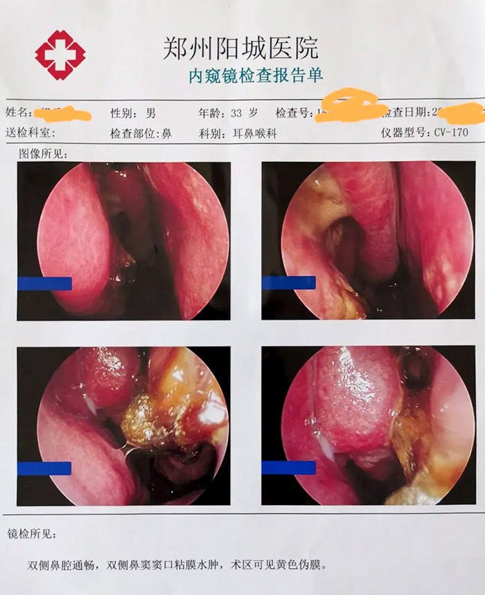 术后一周患者复查鼻内窥镜：术区恢复可。