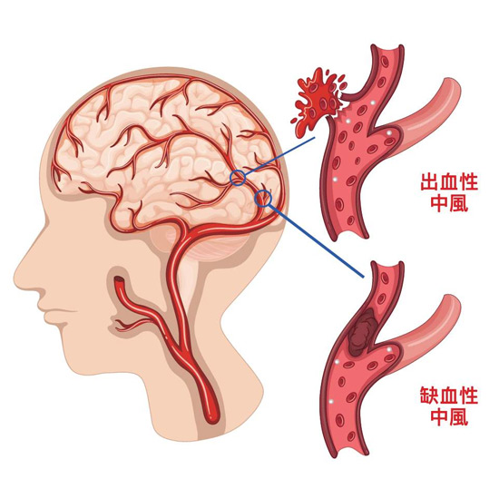 脑中风人群画像治疗费用及预防护理