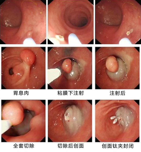 胃肠里长个“小疙瘩”切还是不切？