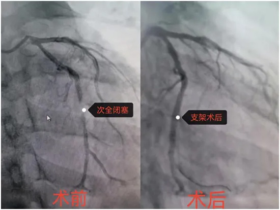 异乡客突发心梗 阳城医院把命救