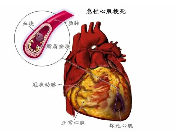 异乡客突发心梗 阳城医院把命救