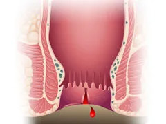 什么是肛裂？什么原因会引起肛裂？