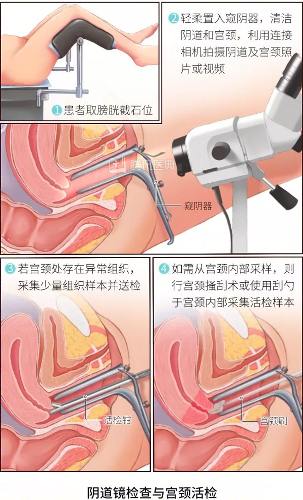 “活检”是什么？怎么做？