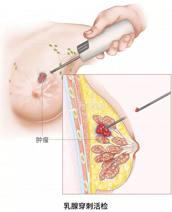 “活检”是什么？怎么做？