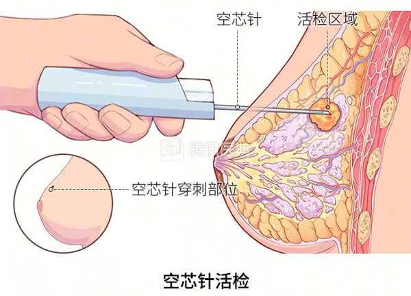 “活检”是什么？怎么做？