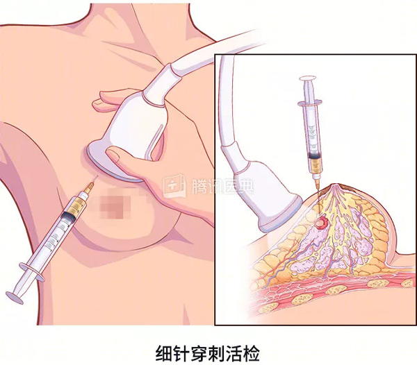 “活检”是什么？怎么做？