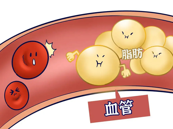 【心脑血管疾病防治行动】这些高血脂的误区你中了几个？