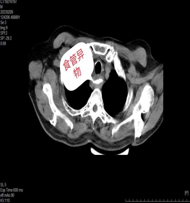 惊险！八旬老人异物卡喉命悬一线，郑州阳城医院内镜团队巧手取出化险为夷