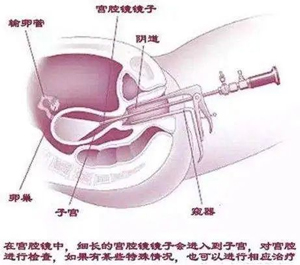 宫腔镜技术