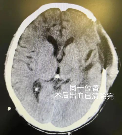 56岁的他，为何时隔10年再发脑出血？