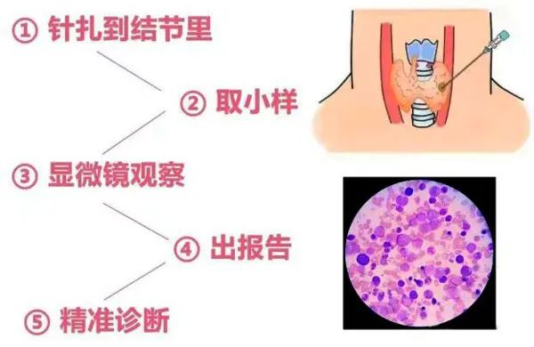 甲状腺癌冲上“热搜”！是良是恶？一针见分晓！