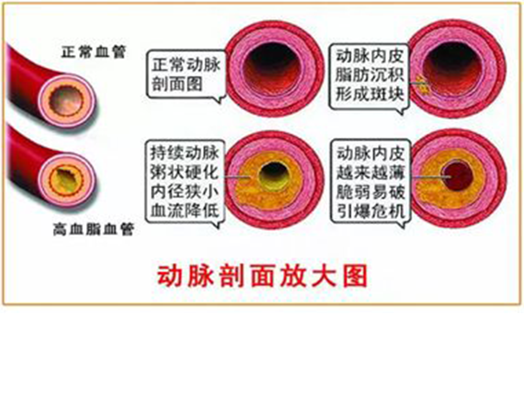 颈动脉刨面图