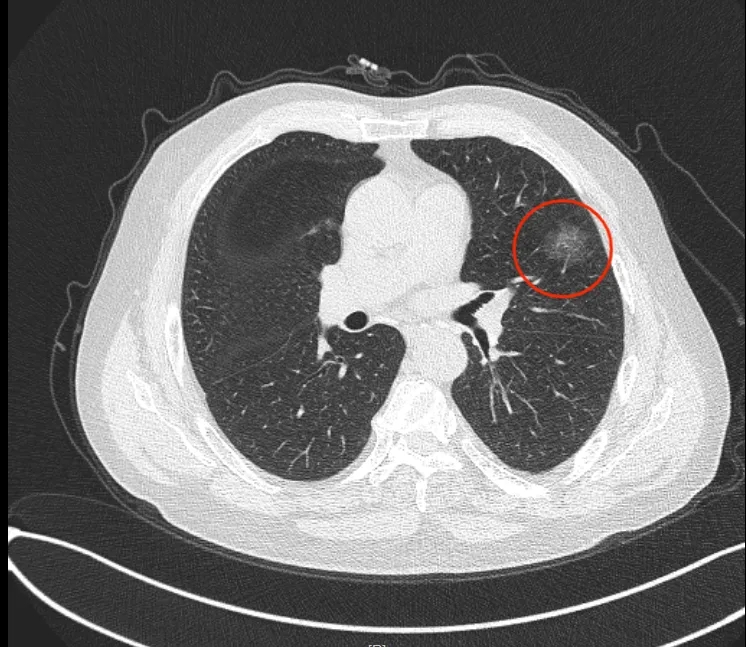 早期肺Ca的“克星”出现了！医生的这波操作亮了！