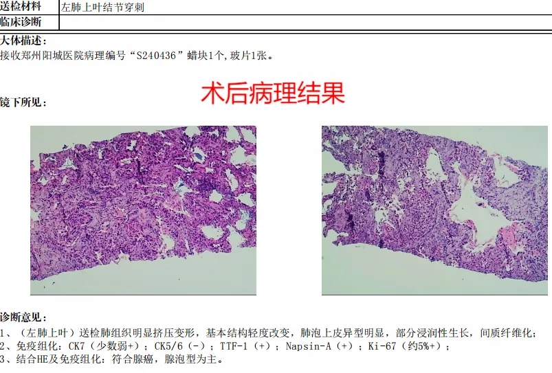 早期肺Ca的“克星”出现了！医生的这波操作亮了！