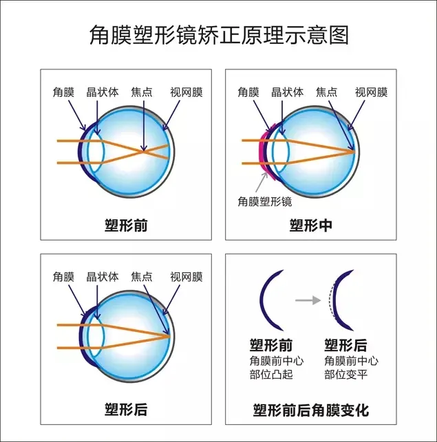 睡梦中延缓近视进展，究竟是什么“黑科技”？