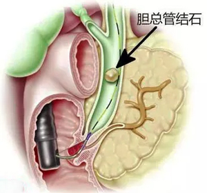 从忽视到重视，“双镜”联合显“微”力，一次攻克多处结石！