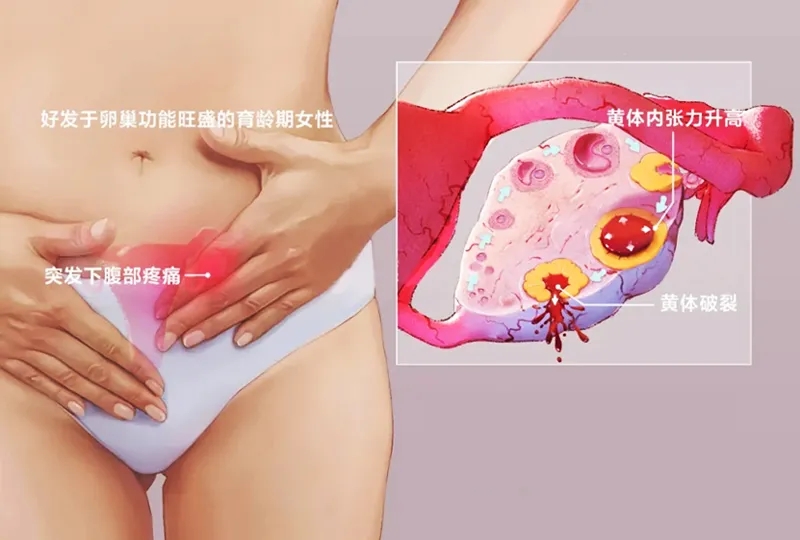 超声“揪出”女性腹痛元凶——黄体破裂，你不可不知！