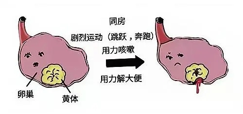 超声“揪出”女性腹痛元凶——黄体破裂，你不可不知！