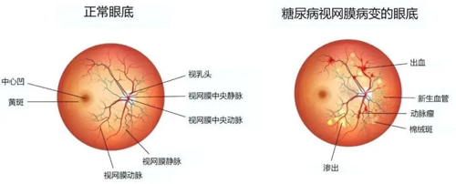 糖尿病患者注意啦！--糖尿病视网膜病变免费筛查来啦！